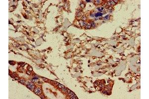 Immunohistochemistry of paraffin-embedded human pancreatic cancer using ABIN7164763 at dilution of 1:100 (PRR11 抗体  (AA 1-360))