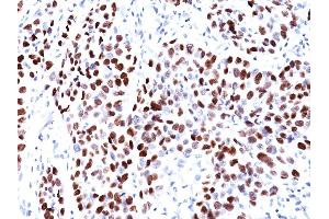 Formalin-fixed, paraffin-embedded human Lung SqCC stained with p21 Mouse Monoclonal Antibody (CIP1/823). (p21 抗体)