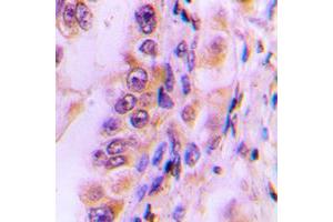 Immunohistochemical analysis of EIF4G2 staining in human liver cancer formalin fixed paraffin embedded tissue section. (EIF4G2 抗体  (N-Term))