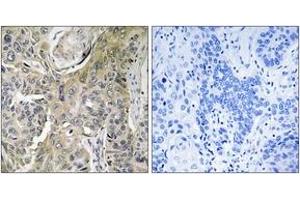 Immunohistochemistry analysis of paraffin-embedded human lung carcinoma tissue, using RHOBTB3 Antibody. (RHOBTB3 抗体  (AA 335-384))