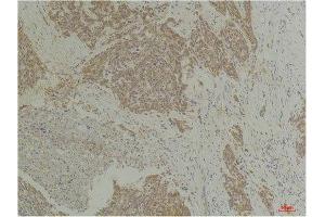 Immunohistochemistry (IHC) analysis of paraffin-embedded Human Breast Carcinoma using CLIC4 Rabbit Polyclonal Antibody diluted at 1:200.