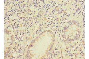 Immunohistochemistry of paraffin-embedded human colon cancer using ABIN7157030 at dilution of 1:100 (IQCC 抗体  (AA 181-466))