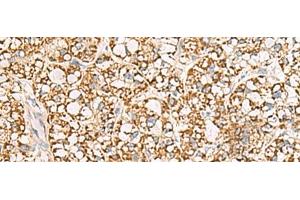 Immunohistochemistry of paraffin-embedded Human liver cancer tissue using ISOC2 Polyclonal Antibody at dilution of 1:95(x200) (ISOC2 抗体)