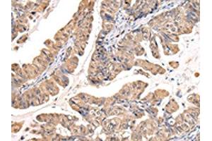 The image on the left is immunohistochemistry of paraffin-embedded Human esophagus cancer tissue using ABIN7127988(PPIL1 Antibody) at dilution 1/30, on the right is treated with fusion protein. (PPIL1 抗体)