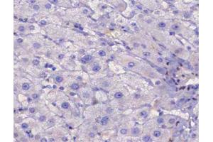 ABIN6267483 at 1/200 staining human liver cancer tissue sections by IHC-P. (IRS1 抗体  (pSer307))