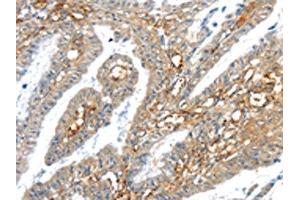 The image on the left is immunohistochemistry of paraffin-embedded Human esophagus cancer tissue using ABIN7192909(TRIM47 Antibody) at dilution 1/30, on the right is treated with synthetic peptide. (TRIM47 抗体)