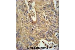 IL5RA Antibody (N-term) (ABIN651428 and ABIN2840234) immunohistochemistry analysis in formalin fixed and paraffin embedded human lung carcinoma followed by peroxidase conjugation of the secondary antibody and DAB staining. (IL5RA 抗体  (N-Term))