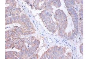 Immunohistochemistry of paraffin-embedded human colon cancer using ABIN7144373 at dilution of 1:100 (AP2S1 抗体  (AA 1-142))