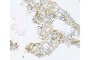 Immunohistochemistry of paraffin-embedded Human mammary cancer using BCL2L2 Polyclonal Antibody at dilution of 1:100 (40x lens). (BCL2L2 抗体)