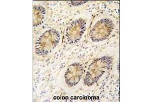 Formalin-fixed and paraffin-embedded human colon carcinoma tissue reacted with AKR1B1 antibody (C-term) (ABIN389205 and ABIN2839363) , which was peroxidase-conjugated to the secondary antibody, followed by DAB staining. (AKR1B1 抗体  (C-Term))