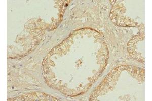 Immunohistochemistry of paraffin-embedded human prostate cancer using ABIN7146273 at dilution of 1:100 (Calcineurin B 抗体  (AA 1-170))