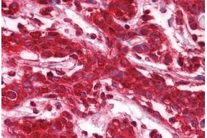 Human Breast: Formalin-Fixed, Paraffin-Embedded (FFPE) (CLIC1 抗体  (AA 1-242))