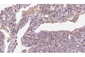 ABIN6273163 at 1/100 staining Human lymph cancer tissue by IHC-P. (SLC38A3 抗体  (Internal Region))