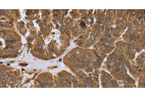 Immunohistochemistry of paraffin-embedded Human ovarian cancer tissue using IKBIP Polyclonal Antibody at dilution 1:40 (IKbIP 抗体)