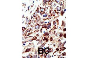 Formalin-fixed and paraffin-embedded human cancer tissue reacted with STAM polyclonal antibody  , which was peroxidase-conjugated to the secondary antibody, followed by AEC staining. (STAM 抗体  (C-Term))