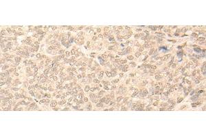 Immunohistochemistry of paraffin-embedded Human ovarian cancer tissue using NARF Polyclonal Antibody at dilution of 1:45(x200) (NARF 抗体)