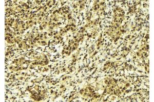 ABIN6273140 at 1/100 staining Human breast cancer tissue by IHC-P.