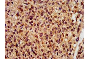 IHC image of ABIN7168275 diluted at 1:400 and staining in paraffin-embedded human glioma performed on a Leica BondTM system. (RBM9 抗体  (AA 8-110))