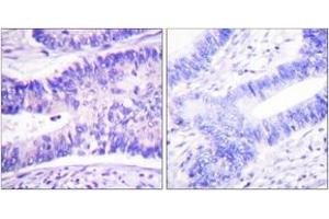 Immunohistochemistry analysis of paraffin-embedded human colon carcinoma, using WAVE1 (Phospho-Tyr125) Antibody. (WASF1 抗体  (pTyr125))