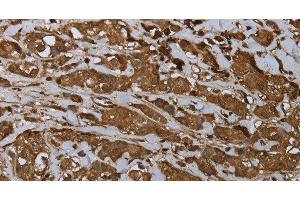 Immunohistochemistry of paraffin-embedded Human breast cancer using ARHGDIA Polyclonal Antibody at dilution of 1:30 (ARHGDIA 抗体)