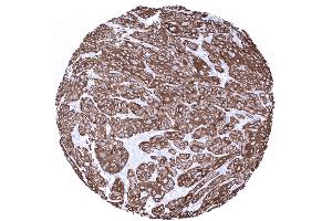 Squamous cell carcinoma of the uterine cervix with strong Cytokeratin 6 positivity (Recombinant Keratin 6 抗体)