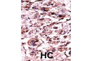 Formalin-fixed and paraffin-embedded human hepatocellular carcinoma tissue reacted with ABL1 (phospho Y245) polyclonal antibody  which was peroxidase-conjugated to the secondary antibody followed by AEC staining. (ABL1 抗体  (pTyr245))