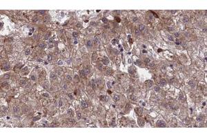 ABIN6273968 at 1/100 staining Human liver cancer tissue by IHC-P. (OR1I1 抗体  (C-Term))