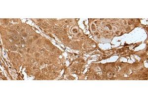 Immunohistochemistry of paraffin-embedded Human esophagus cancer tissue using LIPG Polyclonal Antibody at dilution of 1:50(x200) (LIPG 抗体)