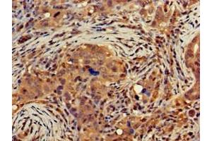 Immunohistochemistry of paraffin-embedded human pancreatic cancer using ABIN7149854 at dilution of 1:100 (DGAT1 抗体  (AA 1-62))