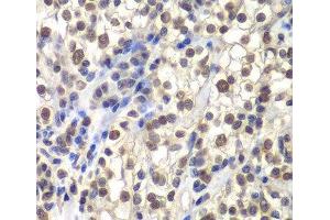 Immunohistochemistry of paraffin-embedded Human kidney cancer using CENPC Polyclonal Antibody at dilution of 1:200 (40x lens). (Centromere Protein C Pseudogene 1 (CENPCP1) 抗体)