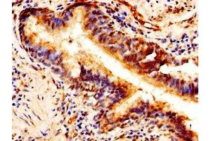 Immunohistochemistry of paraffin-embedded human lung cancer using ABIN7163691 at dilution of 1:100 (Pleiotrophin 抗体  (AA 33-168))