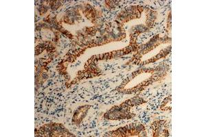 Immunohistochemical analysis of Tetraspanin 8 staining in human colon cancer formalin fixed paraffin embedded tissue section.