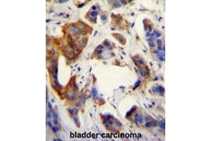 UBFD1 antibody (N-term) immunohistochemistry analysis in formalin fixed and paraffin embedded human bladder carcinoma followed by peroxidase conjugation of the secondary antibody and DAB staining. (UBFD1 抗体  (N-Term))