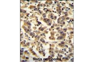 TTC39B antibody (C-term) (ABIN654972 and ABIN2844610) immunohistochemistry analysis in formalin fixed and paraffin embedded human testis carcinoma followed by peroxidase conjugation of the secondary antibody and DAB staining. (TTC39B 抗体  (C-Term))