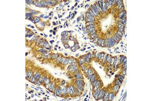Immunohistochemistry of paraffin-embedded human colon carcinoma using TOMM20 antibody at dilution of 1:100 (x40 lens).
