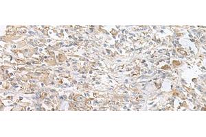 Immunohistochemistry of paraffin-embedded Human liver cancer tissue using PFKM Polyclonal Antibody at dilution of 1:60(x200) (PFKM 抗体)