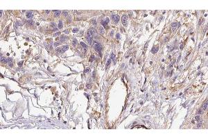 ABIN6273035 at 1/100 staining Human Melanoma tissue by IHC-P. (COL6A1 抗体  (Internal Region))