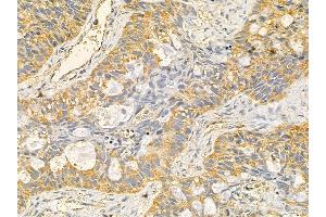RPS23 Mouse Monoclonal Antibody at 1/100 staining human lung cancer and adjacent non-tumor tissue by IHC-P. (RPS23 抗体  (N-Term))