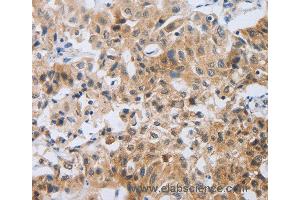 Immunohistochemistry of Human lung cancer using NEB Polyclonal Antibody at dilution of 1:80 (Nebulin 抗体)
