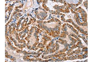 The image on the left is immunohistochemistry of paraffin-embedded Human thyroid cancer tissue using ABIN7130278(MSMB Antibody) at dilution 1/30, on the right is treated with fusion protein. (MSMB 抗体)