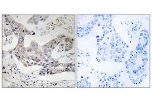 Immunohistochemistry analysis of paraffin-embedded human breast carcinoma tissue, using ALDH3B1 antibody.