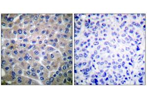 Immunohistochemical analysis of paraffin-embedded human breast carcinoma tissue using p130 Cas (epitope around residue 410) antibody (ABIN5976160). (BCAR1 抗体  (Tyr410))
