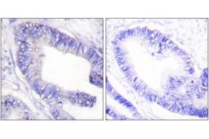 Immunohistochemistry analysis of paraffin-embedded human colon carcinoma, using IRS-1 (Phospho-Ser1101) Antibody. (IRS1 抗体  (pSer1101))