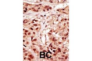 Formalin-fixed and paraffin-embedded human cancer tissue reacted with the primary antibody, which was peroxidase-conjugated to the secondary antibody, followed by DAB staining. (TP53RK 抗体  (AA 220-249))