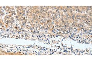 Immunohistochemistry of paraffin-embedded Human lung cancer tissue using BPIFB2 Polyclonal Antibody at dilution 1:45 (BPIL1 抗体)