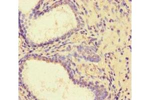Immunohistochemistry of paraffin-embedded human prostate cancer using ABIN7162730 at dilution of 1:100 (PDLIM5 抗体  (AA 268-404))