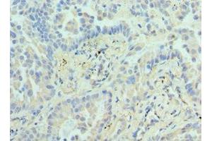 Immunohistochemistry of paraffin-embedded human lung cancer using ABIN7155474 at dilution of 1:100 (EZH1 抗体  (AA 160-280))