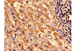 Immunocytochemistry analysis of human liver cancer using ABIN7171000 at dilution of 1:100 (SOCS3 抗体  (AA 1-224))