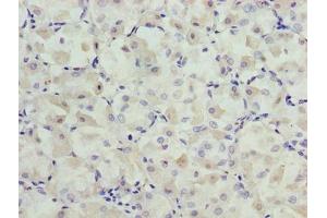 Immunohistochemistry of paraffin-embedded human gastric cancer using ABIN7164554 at dilution of 1:100 (SLC31A2 抗体  (AA 44-93))