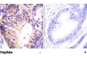 Immunohistochemical analysis of paraffin-embedded human colon carcinoma tissue using PAK1 polyclonal antibody . (PAK1 抗体)